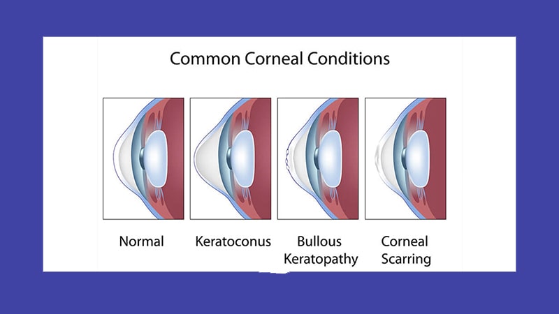 لنز سخت برای قوز قرنیه: آیا درمان با این لنز امکان پذیر است؟ 22 تفاوت بین لنز نرم و لنز سخت برای قوز قرنیه