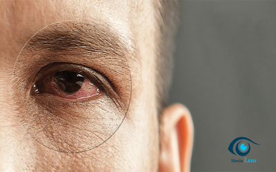 مدت زمان استفاده از لنز اسکلرال; خشکی چشم