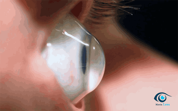 استفاده از لنز سخت برای قوز قرنیه