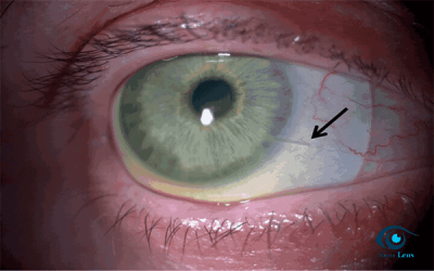 عوارض لنز اسکلرال ؛ استفاده از قطره های مرطوب کننده استاندارد