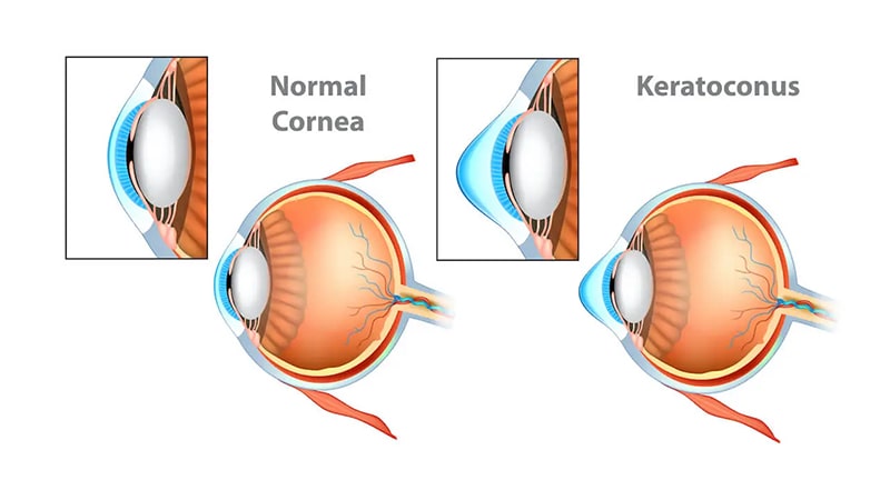 درمان جدید قوز قرنیه با کمک تصویربرداری سه‌بعدی