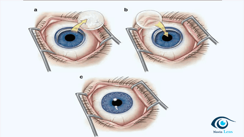 لنز سخت برای قوز قرنیه؛ پیوند قرنیه