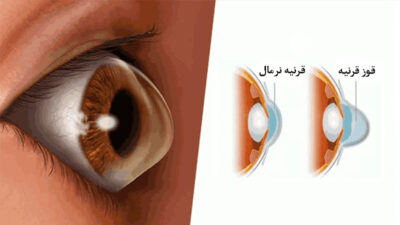 Blog 155 قوز قرنیه; novinlens.com